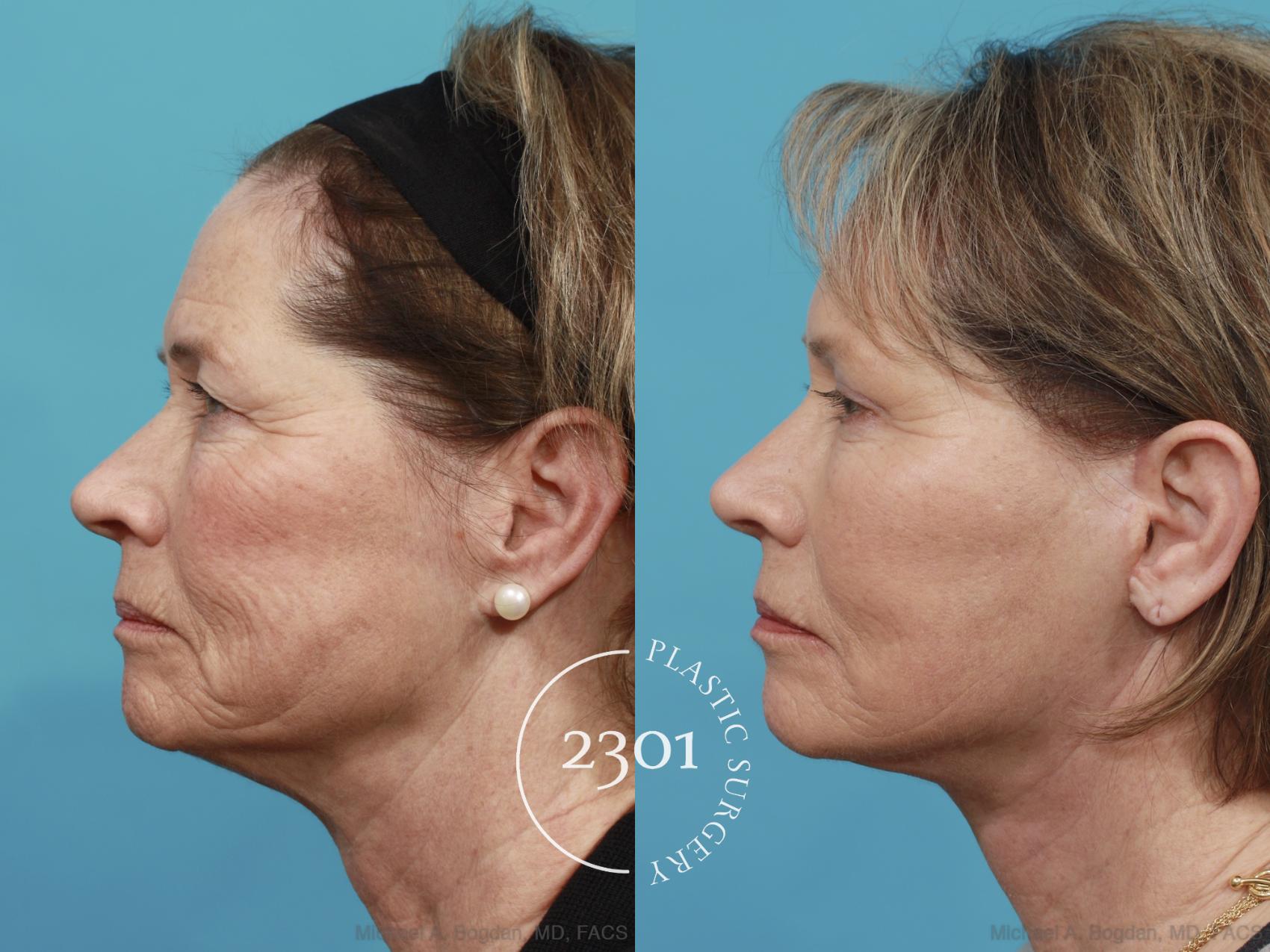 Before & After Face Lift Case 477 View #3 View in Fort Worth, Plano, & Frisco, Texas