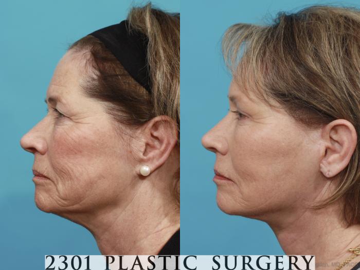 Before & After Face Lift Case 477 View #3 View in Fort Worth, Plano, & Frisco, Texas