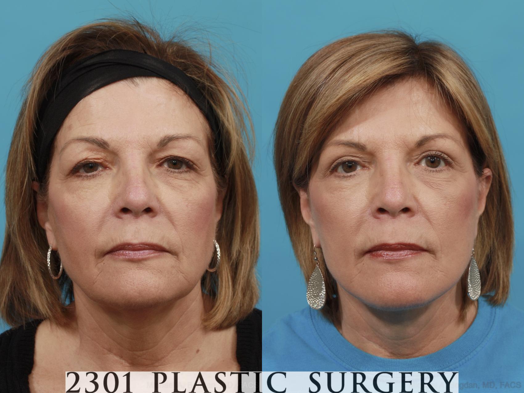 Before & After Blepharoplasty Case 479 View #1 View in Fort Worth & Frisco, Texas