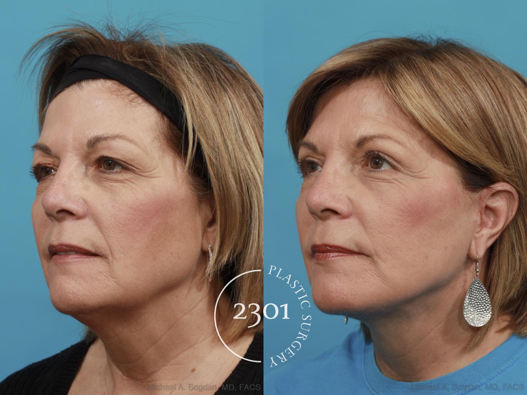 Before & After Blepharoplasty Case 479 View #2 View in Fort Worth, Plano, & Frisco, Texas
