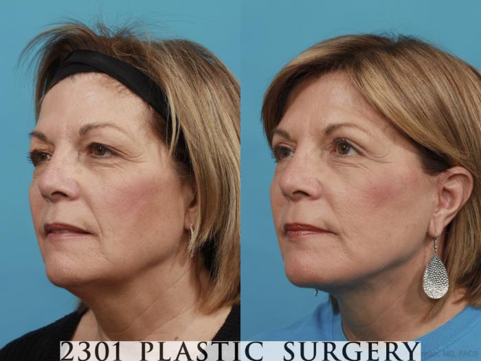 Before & After Blepharoplasty Case 479 View #2 View in Fort Worth, Plano, & Frisco, Texas