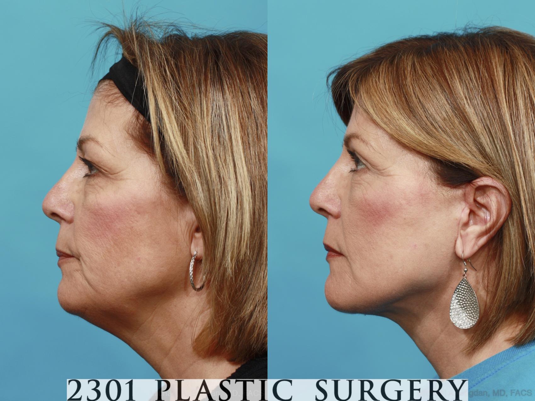 Before & After Face Lift Case 479 View #3 View in Fort Worth & Frisco, Texas
