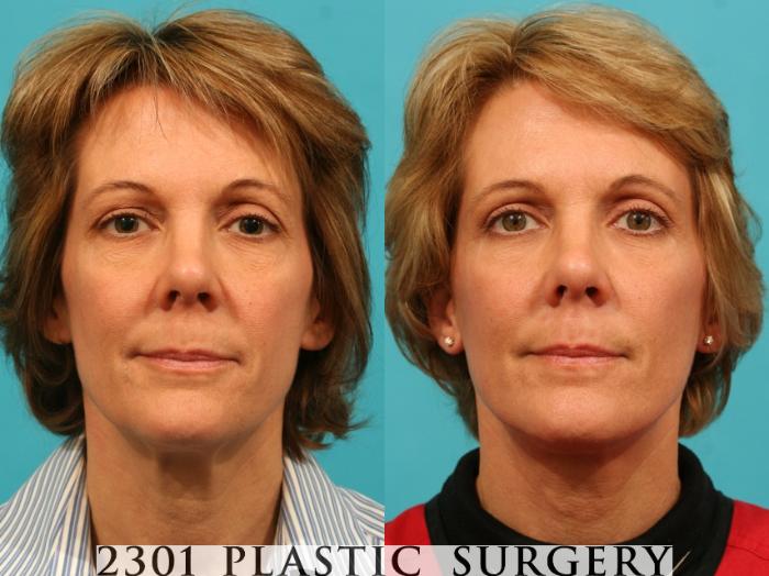 Before & After Neck Lift Case 48 View #1 View in Fort Worth, Plano, & Frisco, Texas