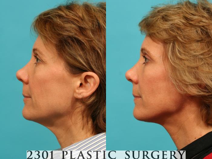 Before & After Neck Lift Case 48 View #2 View in Fort Worth, Plano, & Frisco, Texas