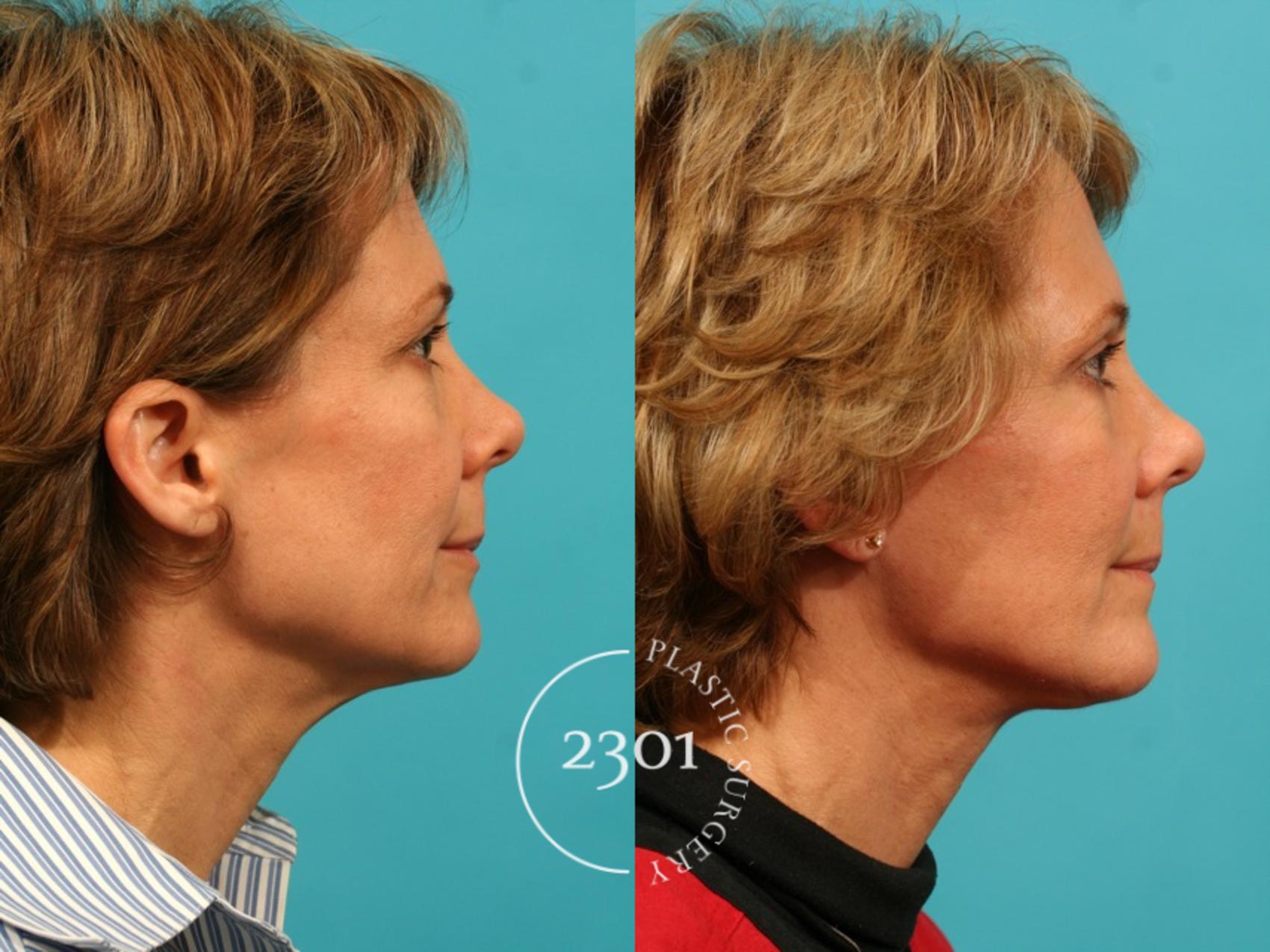 Before & After Blepharoplasty Case 48 View #3 View in Fort Worth, Plano, & Frisco, Texas