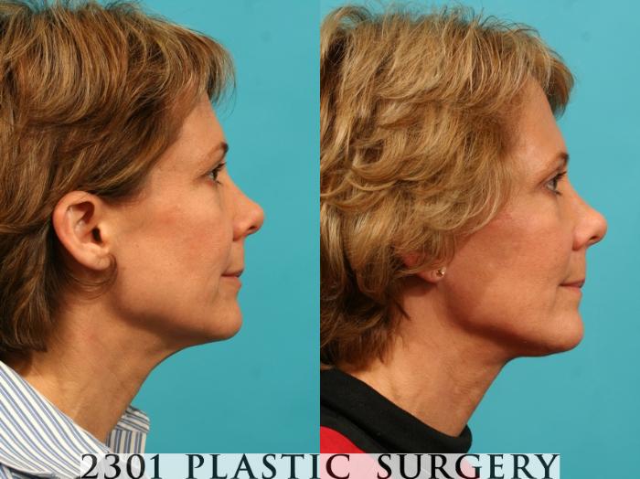 Before & After Blepharoplasty Case 48 View #3 View in Fort Worth, Plano, & Frisco, Texas