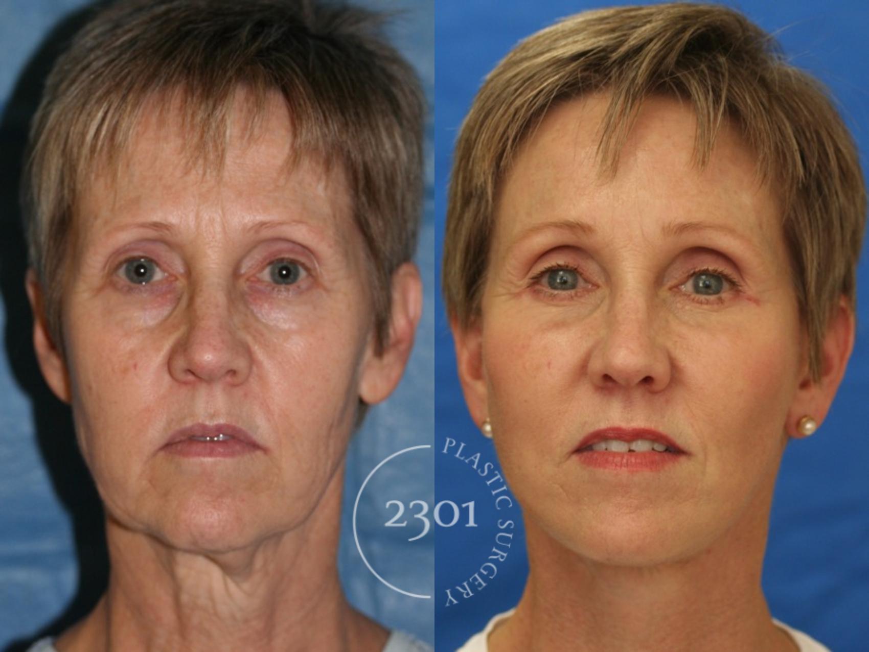 Before & After Face Lift Case 52 View #1 View in Fort Worth, Plano, & Frisco, Texas