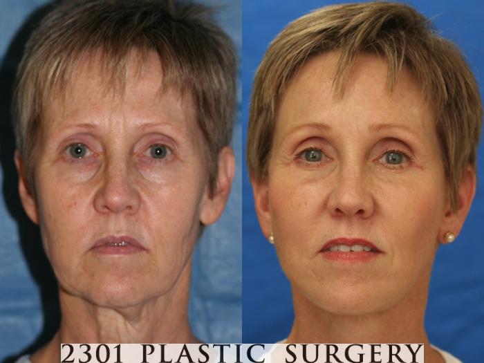 Before & After Neck Lift Case 52 View #1 View in Fort Worth & Frisco, Texas