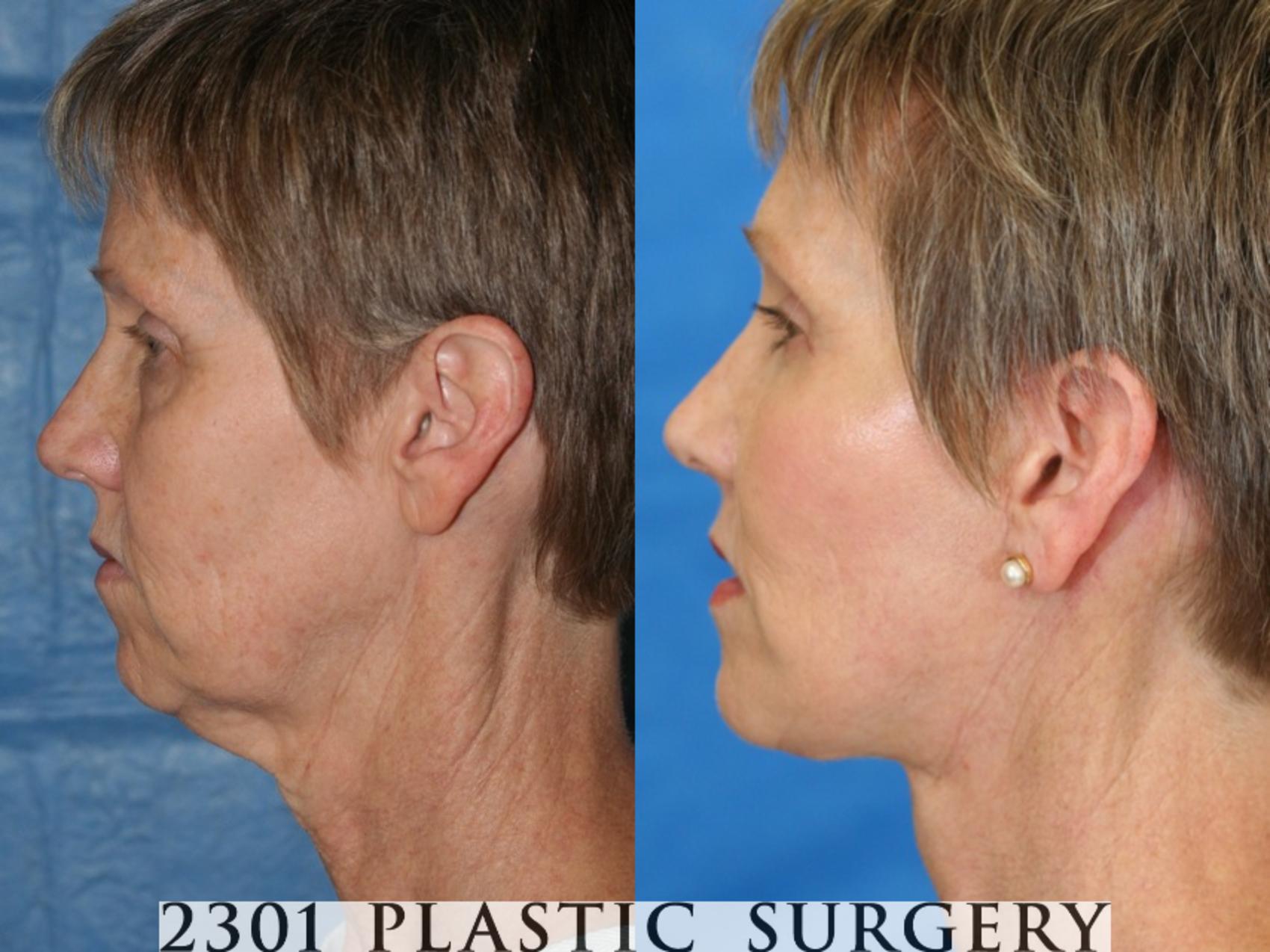 Before & After Face Lift Case 52 View #2 View in Fort Worth, Plano, & Frisco, Texas