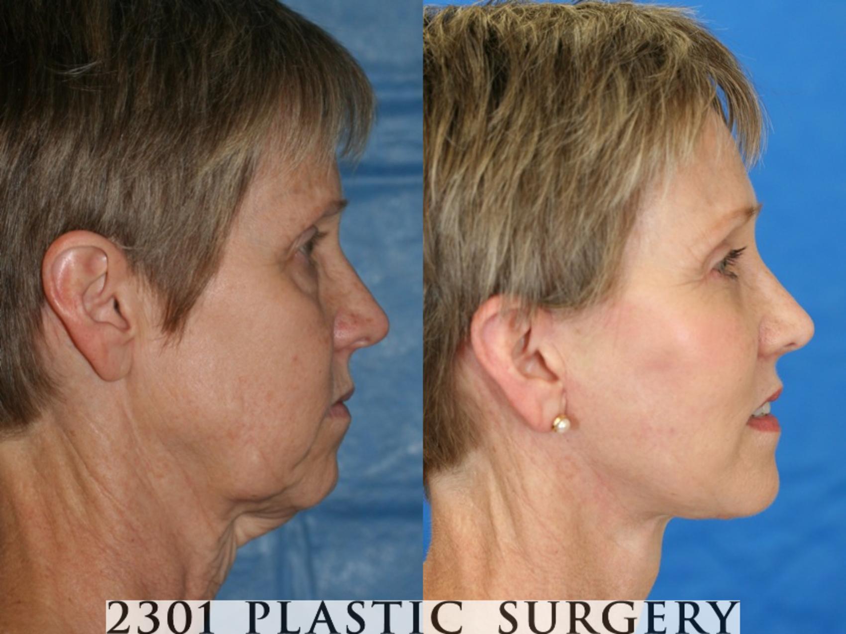 Before & After Face Lift Case 52 View #3 View in Fort Worth & Frisco, Texas