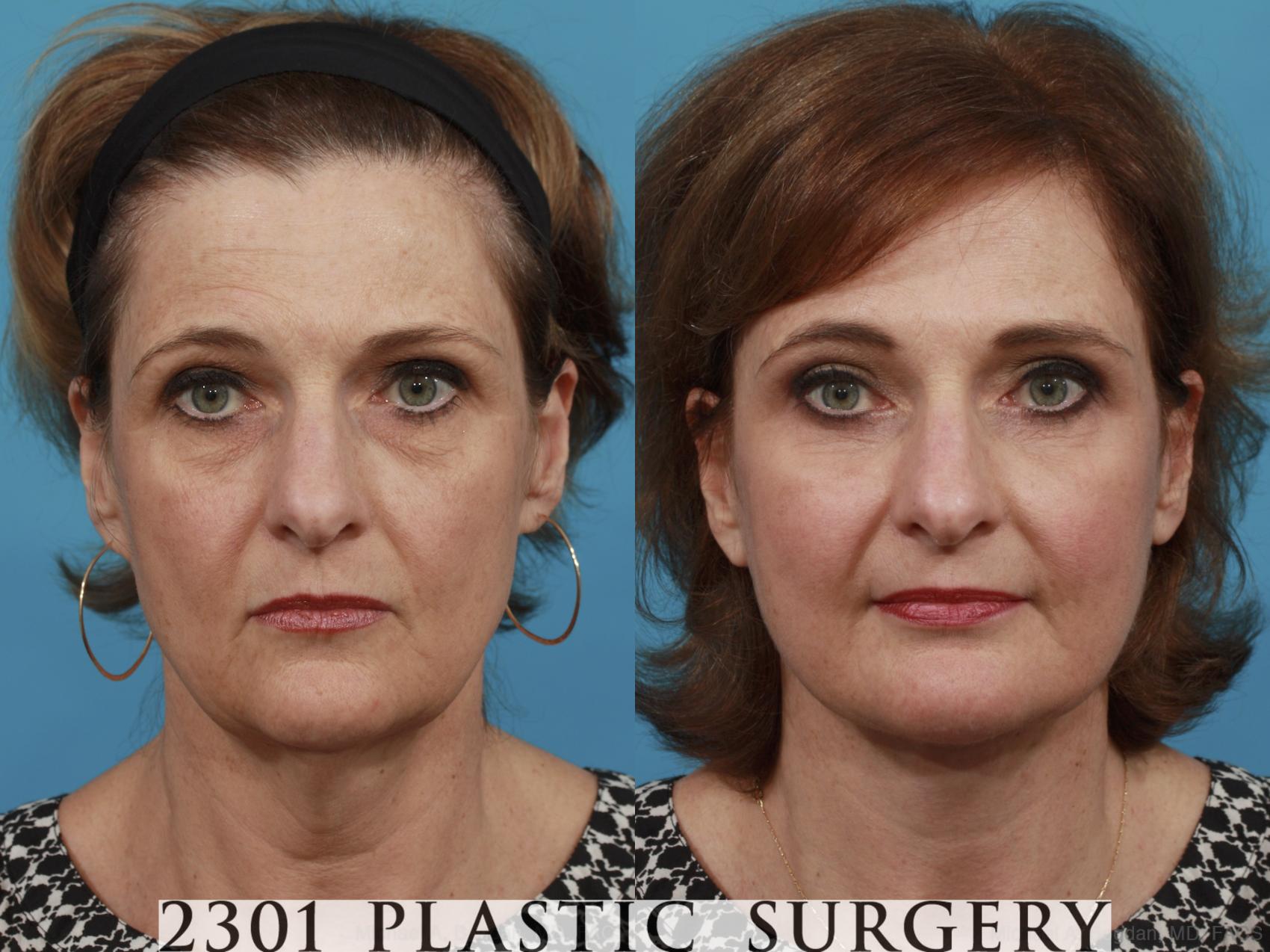 Before & After Face Lift Case 533 View #1 View in Fort Worth & Frisco, Texas