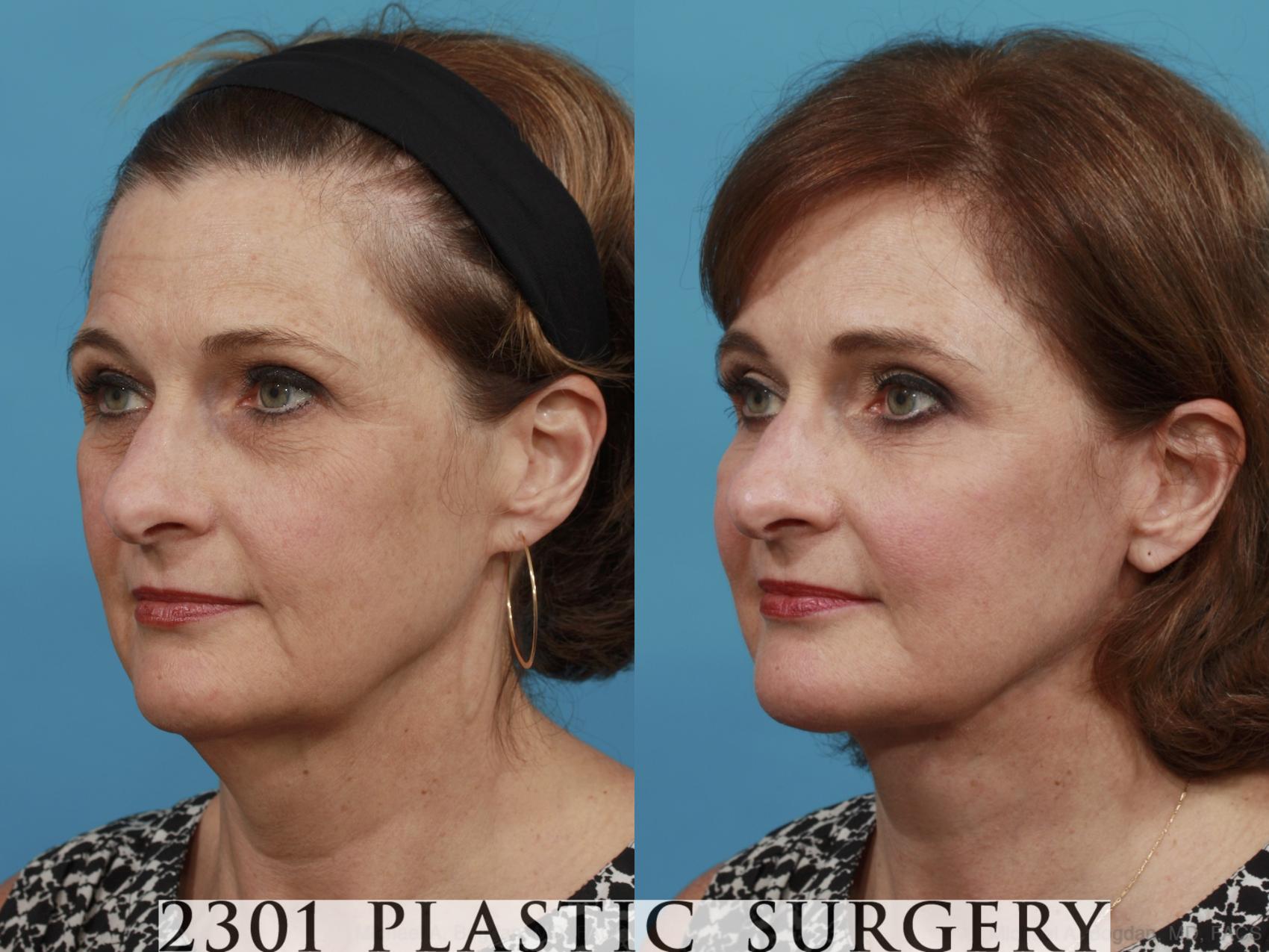 Before & After Face Lift Case 533 View #2 View in Fort Worth & Frisco, Texas