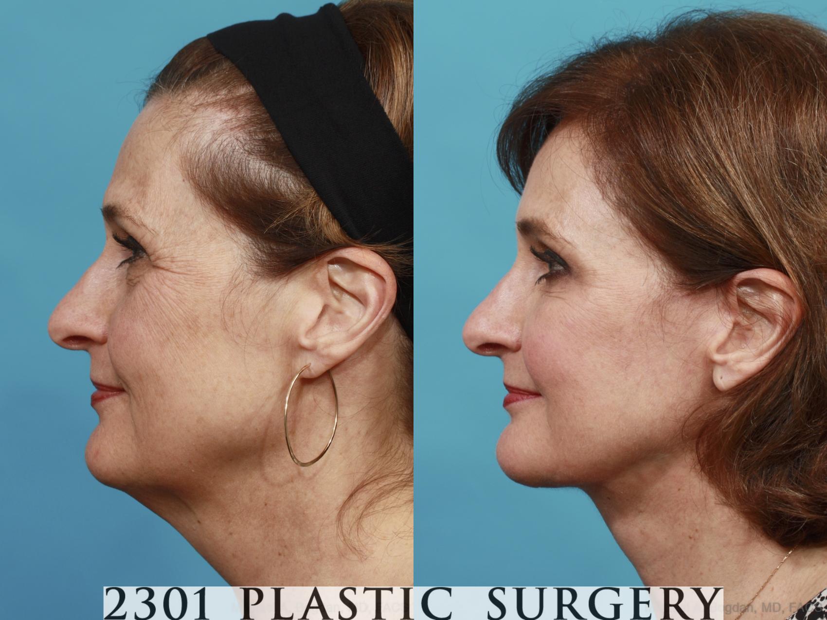 Before & After Face Lift Case 533 View #3 View in Fort Worth & Frisco, Texas