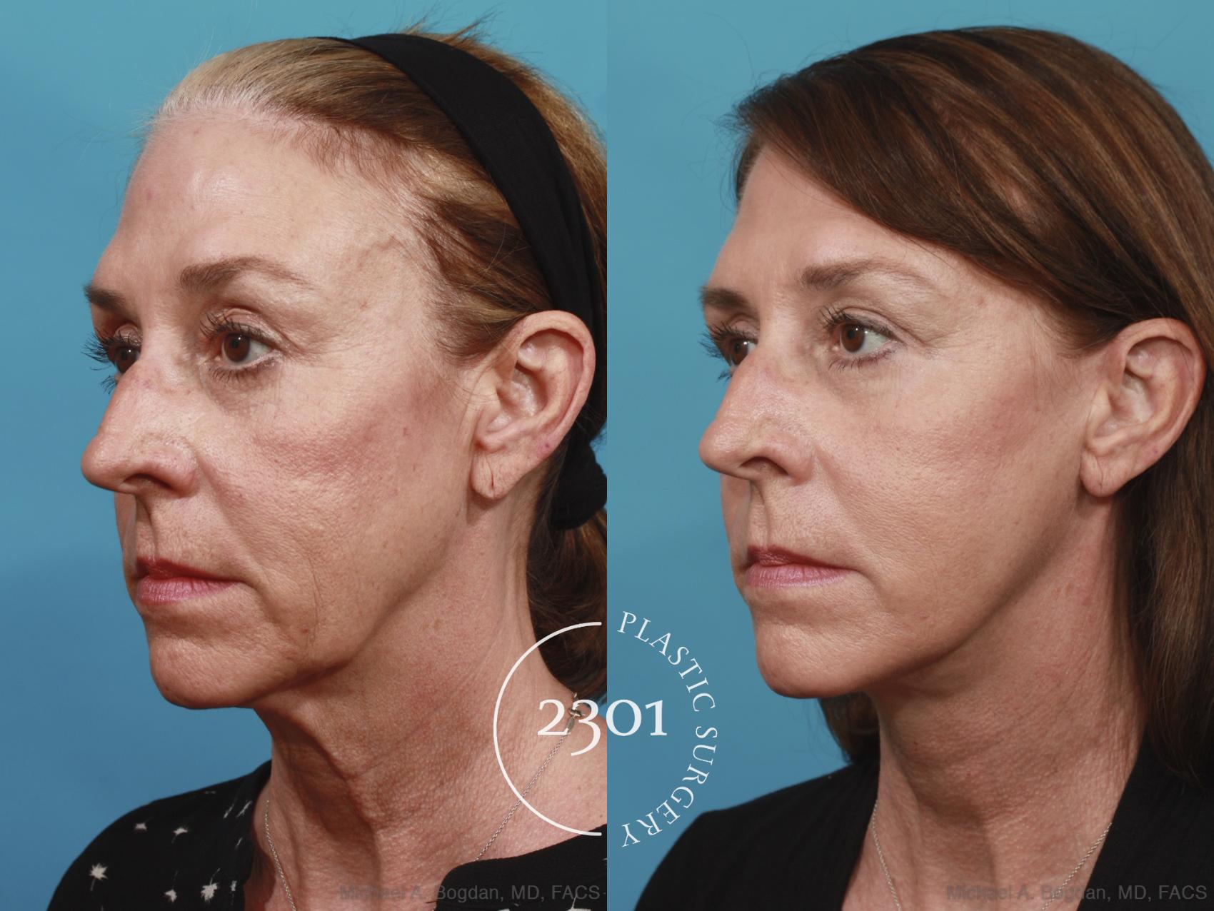 Before & After Face Lift Case 576 View #2 View in Fort Worth, Plano, & Frisco, Texas