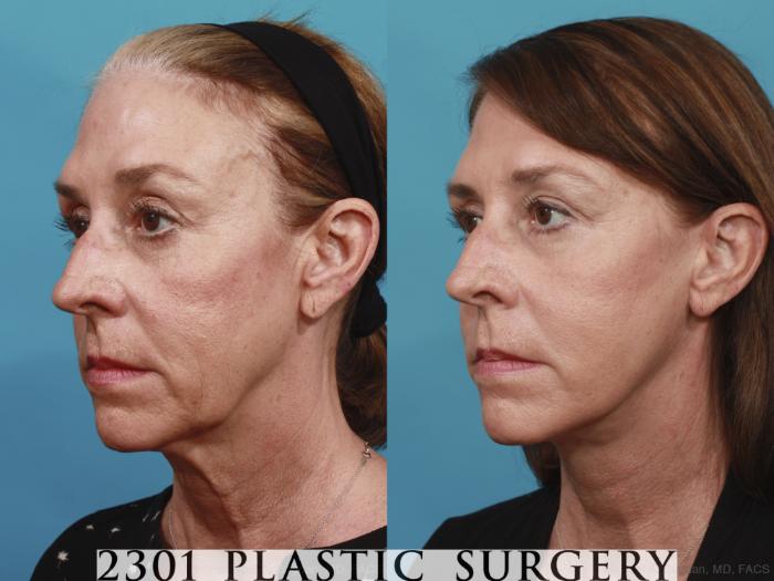 Before & After Neck Lift Case 576 View #2 View in Fort Worth, Plano, & Frisco, Texas