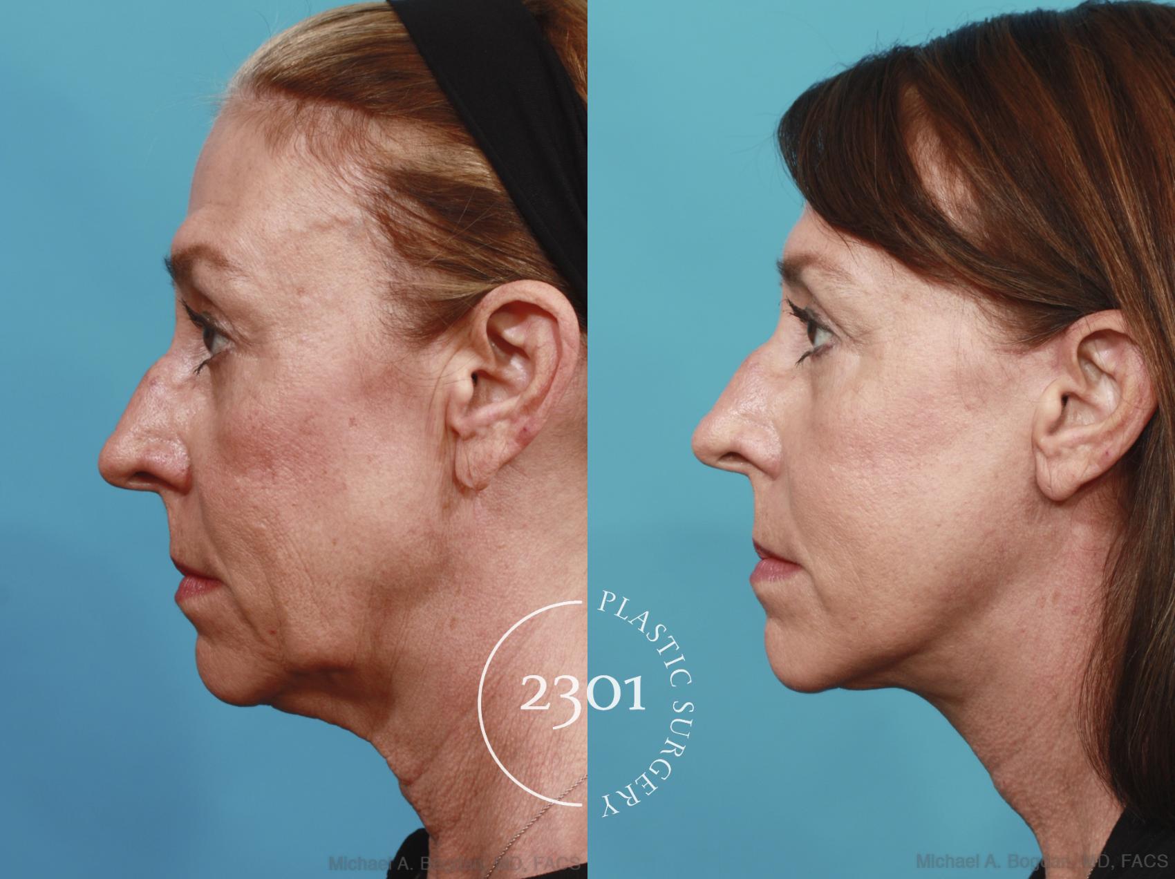 Before & After Face Lift Case 576 View #3 View in Fort Worth, Plano, & Frisco, Texas