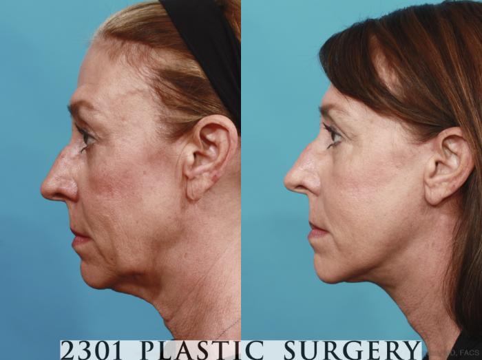 Before & After Face Lift Case 576 View #3 View in Fort Worth, Plano, & Frisco, Texas