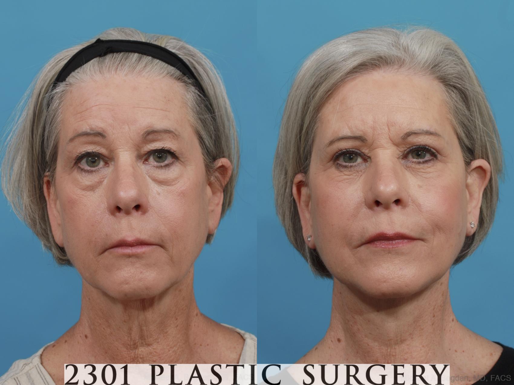 Before & After Blepharoplasty Case 579 View #1 View in Fort Worth, Plano, & Frisco, Texas