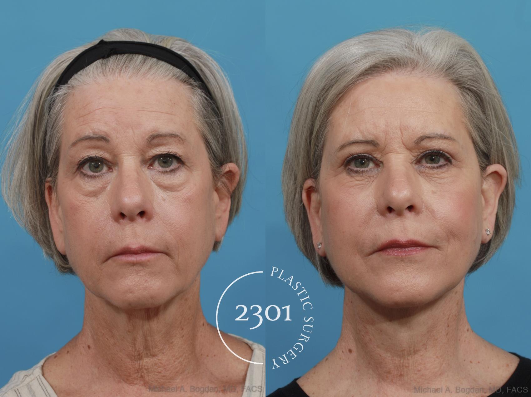 Before & After Face Lift Case 579 View #1 View in Fort Worth, Plano, & Frisco, Texas