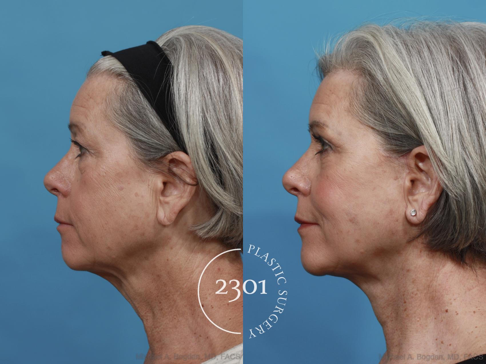 Before & After Face Lift Case 579 View #2 View in Fort Worth, Plano, & Frisco, Texas