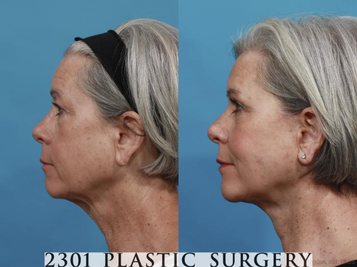 Before & After Face Lift Case 579 View #2 View in Fort Worth, Plano, & Frisco, Texas