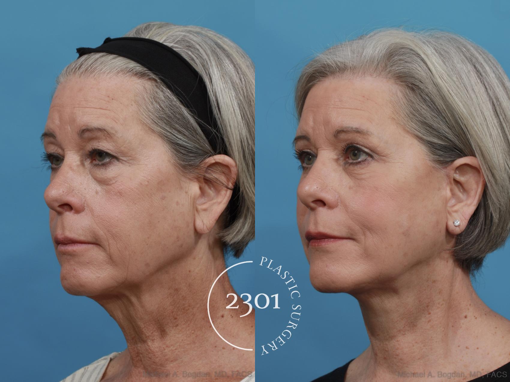 Before & After Face Lift Case 579 View #3 View in Fort Worth, Plano, & Frisco, Texas