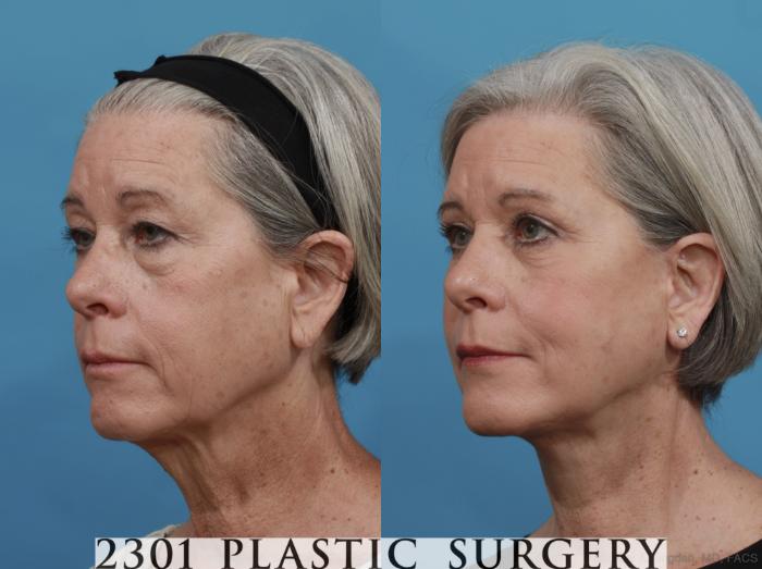 Before & After Face Lift Case 579 View #3 View in Fort Worth, Plano, & Frisco, Texas