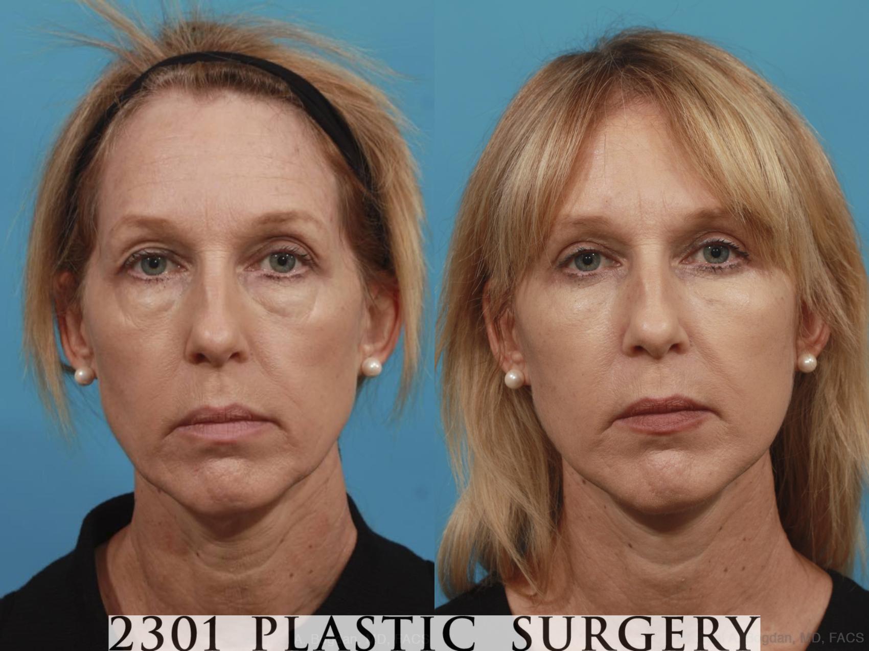Before & After Blepharoplasty Case 580 View #1 View in Fort Worth, Plano, & Frisco, Texas