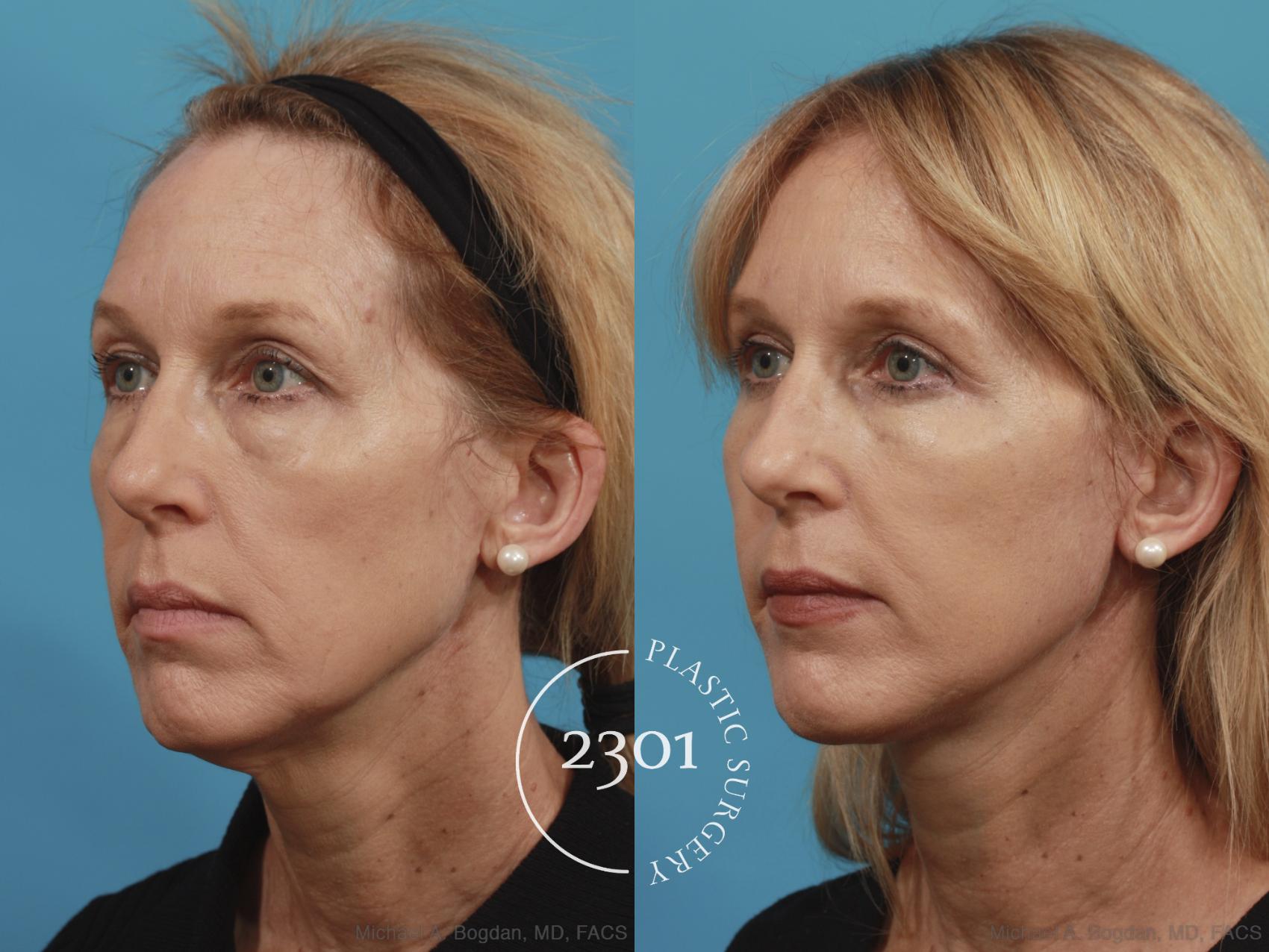 Before & After Neck Lift Case 580 View #2 View in Fort Worth, Plano, & Frisco, Texas