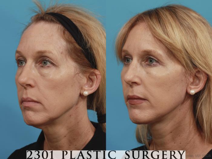 Before & After Face Lift Case 580 View #2 View in Fort Worth, Plano, & Frisco, Texas