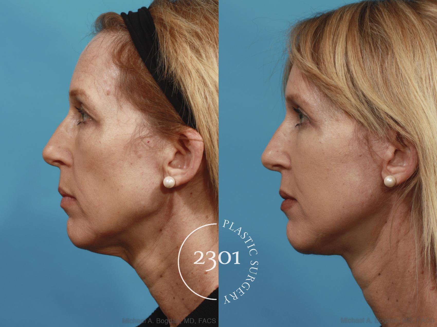 Before & After Neck Lift Case 580 View #3 View in Fort Worth, Plano, & Frisco, Texas