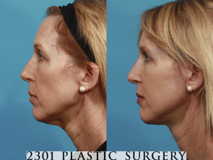 Before & After Neck Lift Case 580 View #3 View in Fort Worth, Plano, & Frisco, Texas
