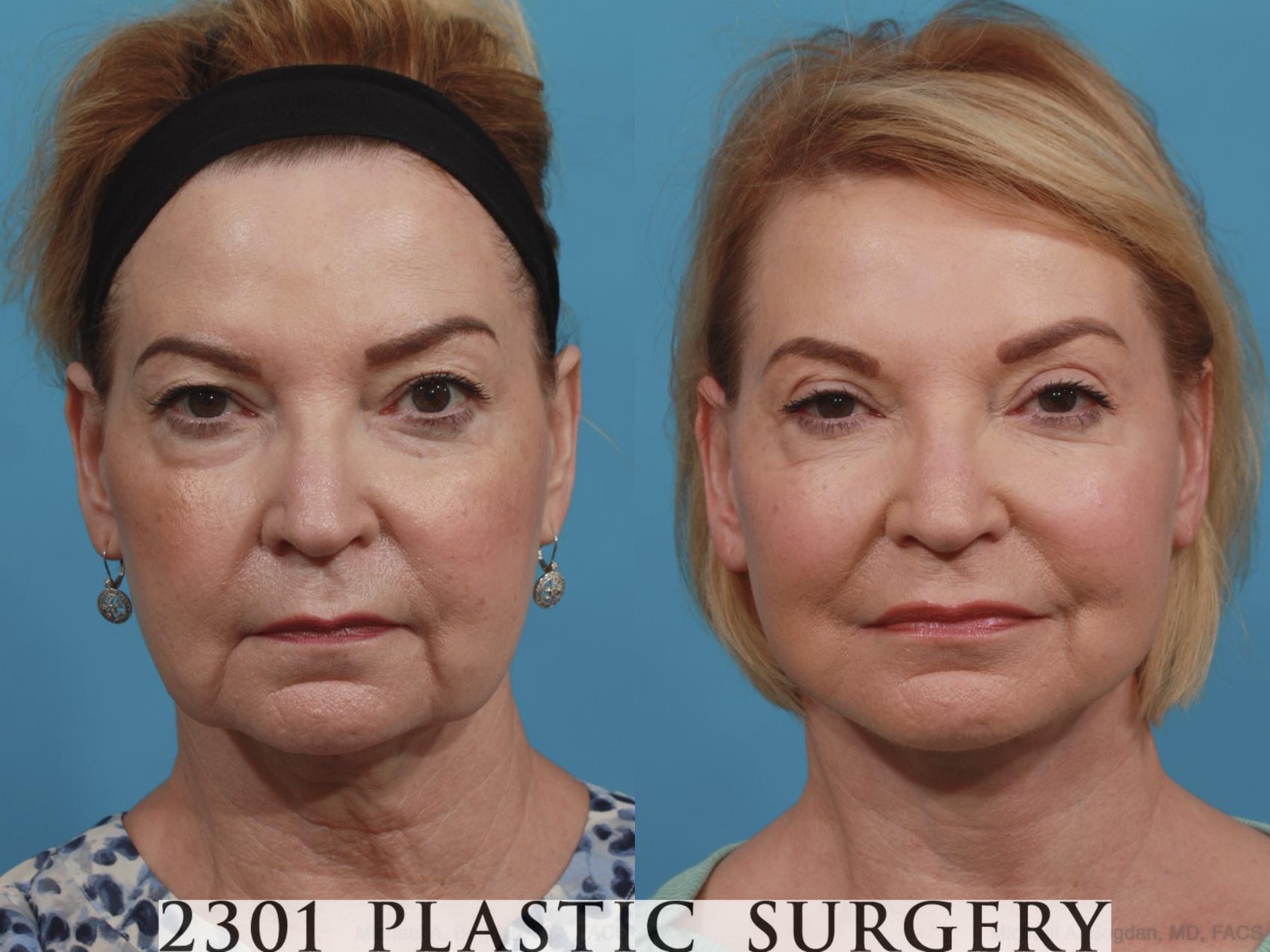 Before & After Neck Lift Case 587 View #1 View in Fort Worth, Plano, & Frisco, Texas