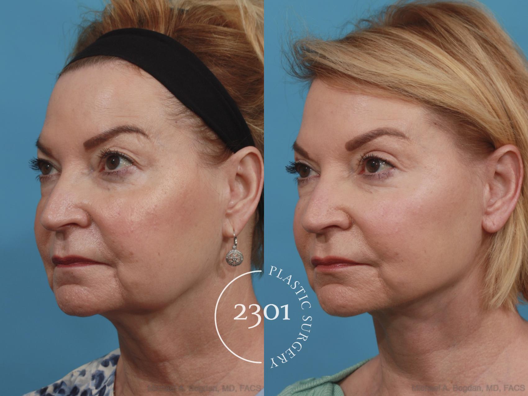 Before & After Blepharoplasty Case 587 View #2 View in Fort Worth, Plano, & Frisco, Texas