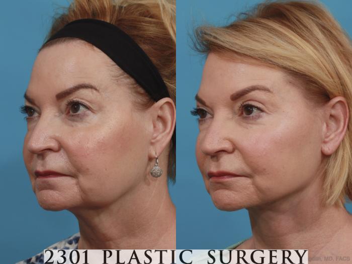 Before & After Neck Lift Case 587 View #2 View in Fort Worth, Plano, & Frisco, Texas