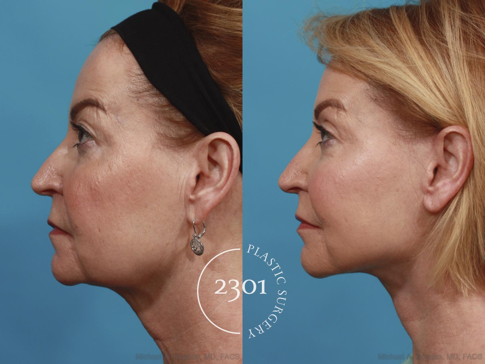 Before & After Blepharoplasty Case 587 View #3 View in Fort Worth, Plano, & Frisco, Texas