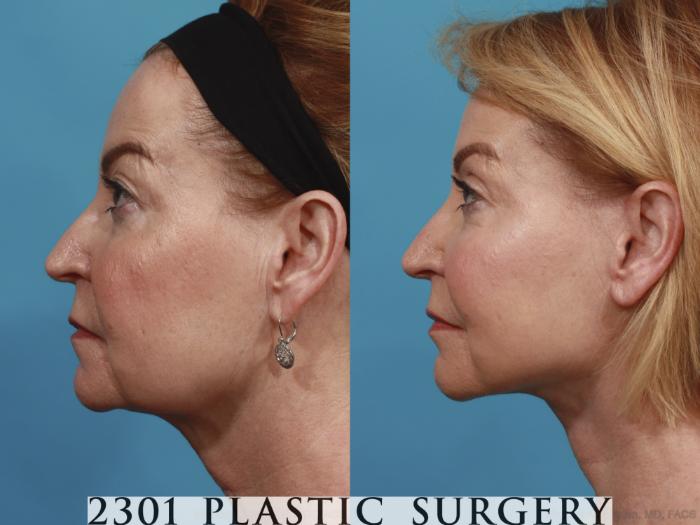Before & After Face Lift Case 587 View #3 View in Fort Worth, Plano, & Frisco, Texas