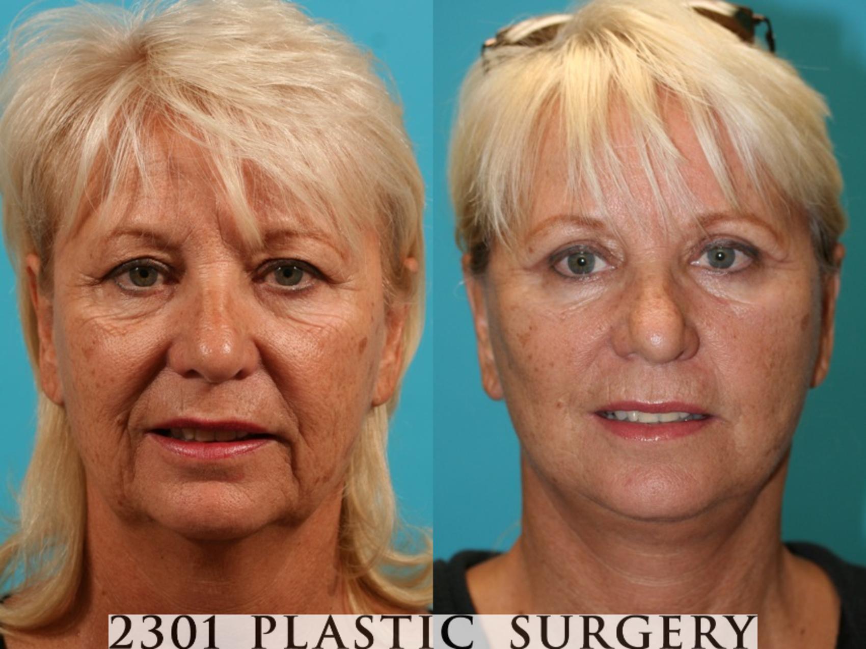 Before & After Face Lift Case 60 View #1 View in Fort Worth, Plano, & Frisco, Texas