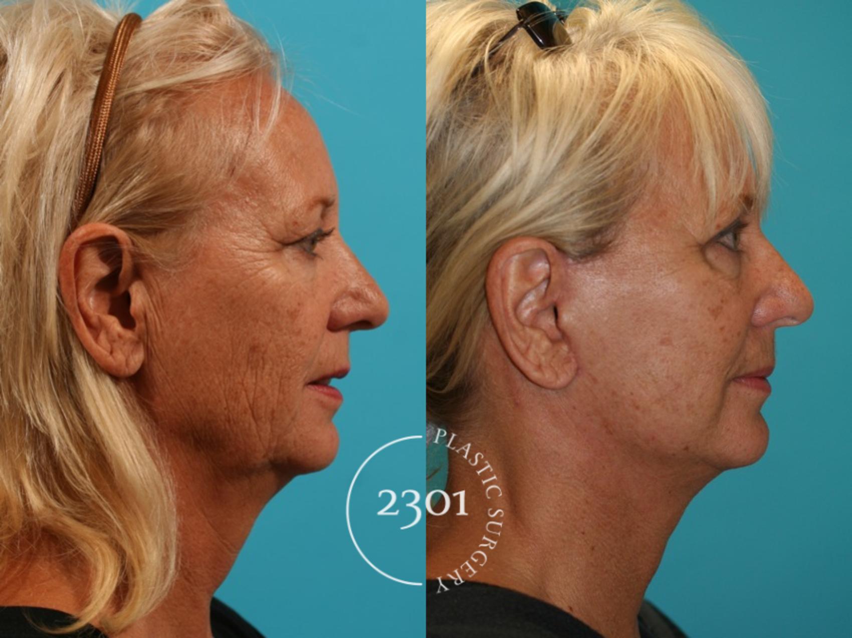 Before & After Neck Lift Case 60 View #2 View in Fort Worth, Plano, & Frisco, Texas