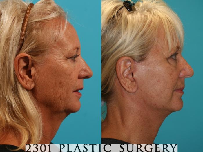 Before & After Face Lift Case 60 View #2 View in Fort Worth, Plano, & Frisco, Texas