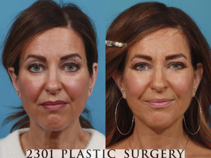 Before & After Blepharoplasty Case 633 Front View in Fort Worth, Plano, & Frisco, Texas