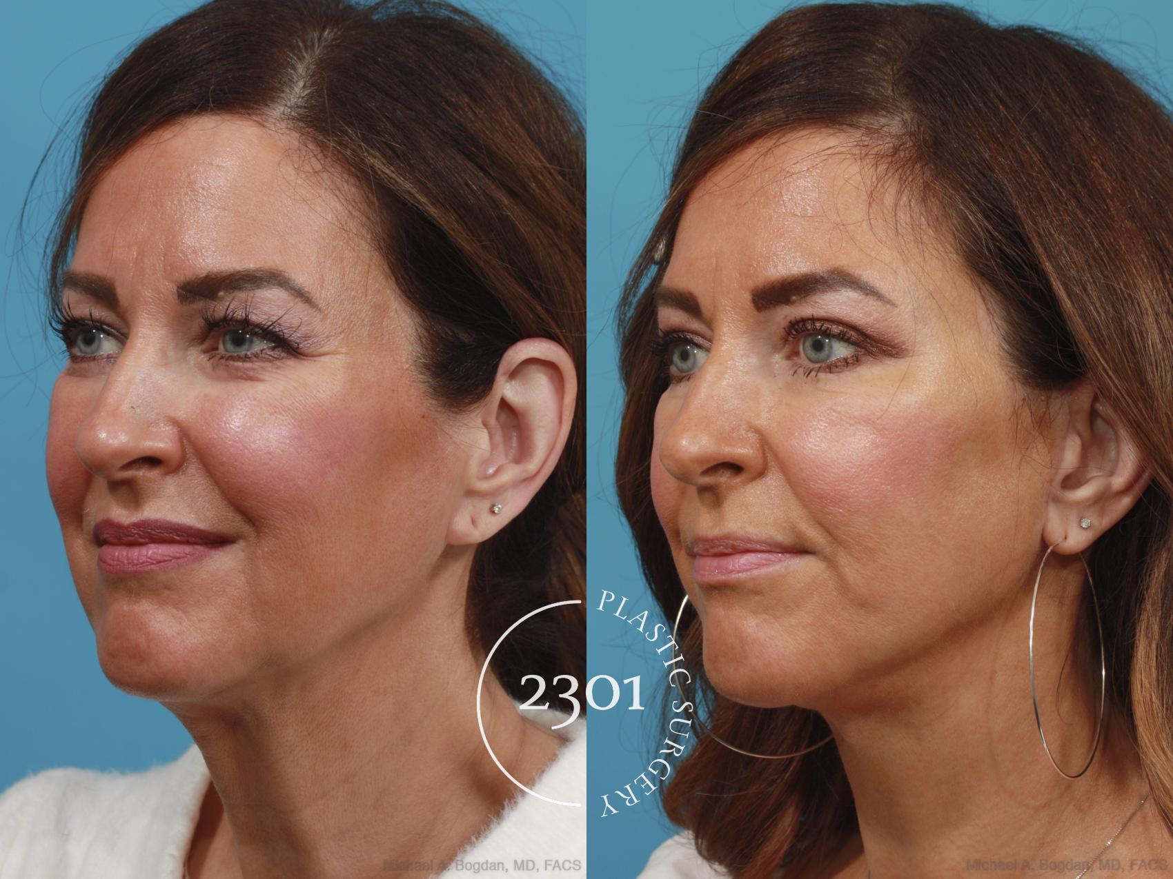 Before & After Face Lift Case 633 Left Oblique View in Fort Worth, Plano, & Frisco, Texas