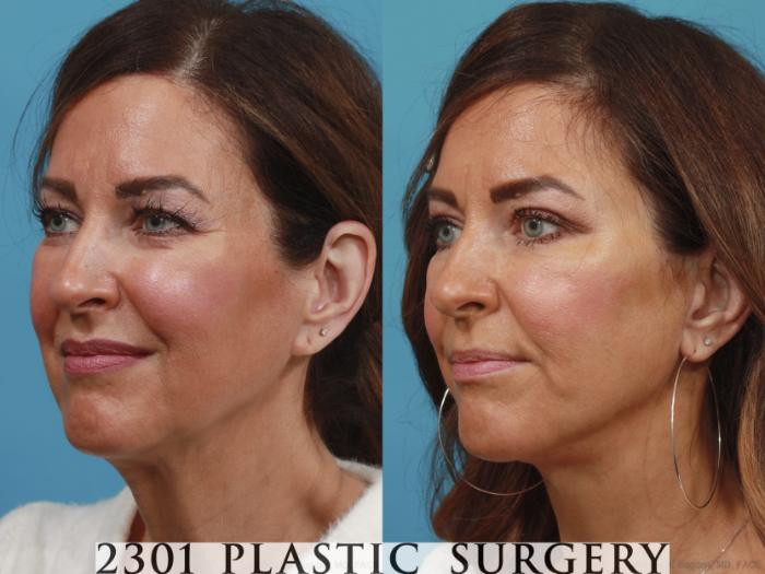 Before & After Blepharoplasty Case 633 Left Oblique View in Fort Worth, Plano, & Frisco, Texas
