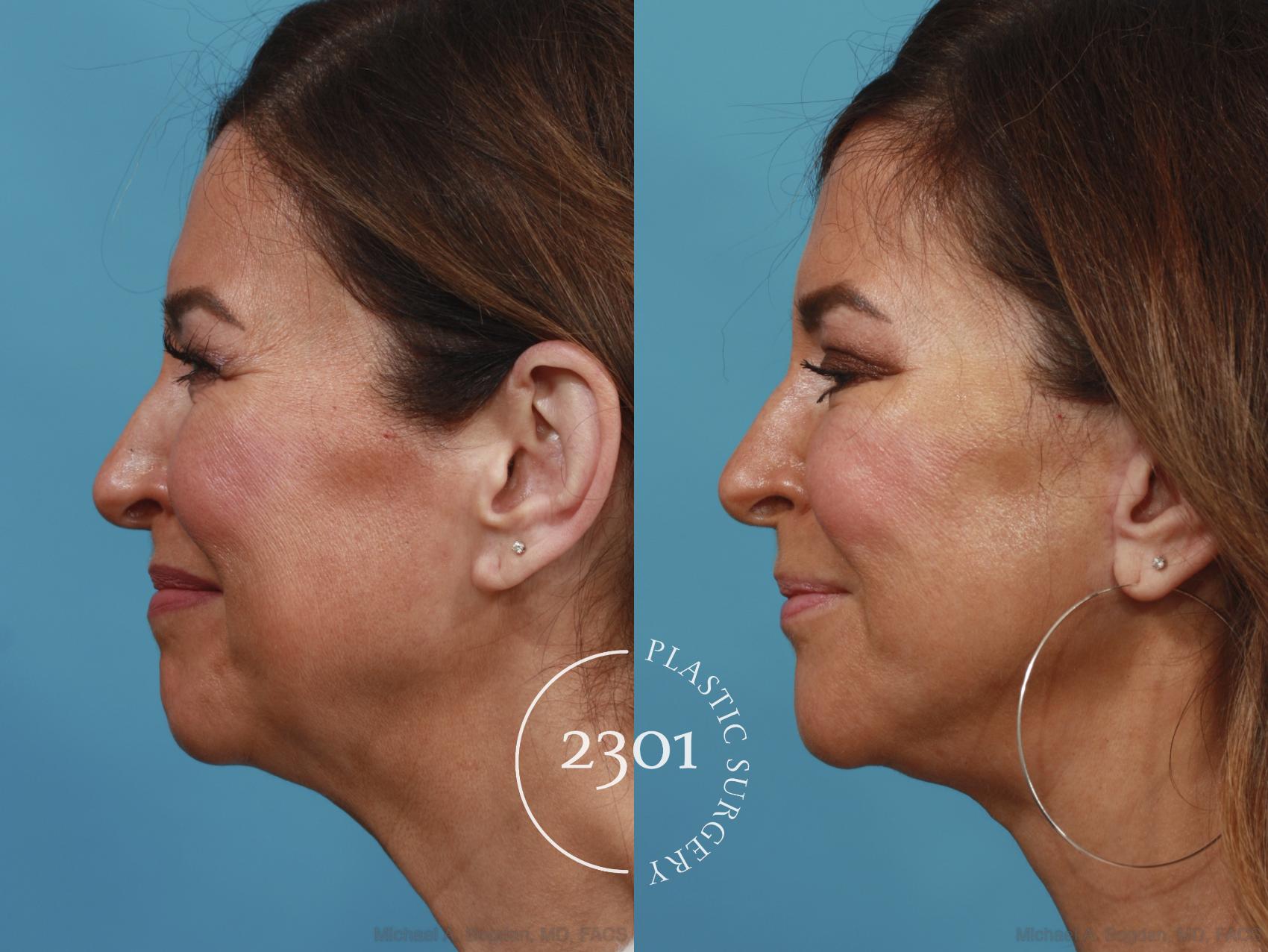 Before & After Face Lift Case 633 Left Side View in Fort Worth, Plano, & Frisco, Texas