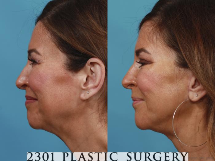 Before & After Blepharoplasty Case 633 Left Side View in Fort Worth, Plano, & Frisco, Texas