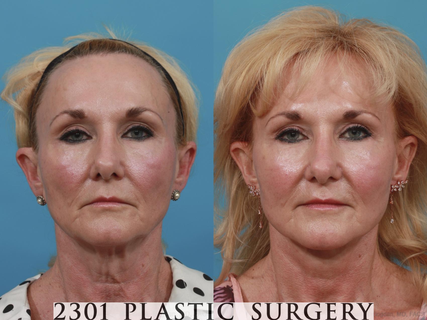 Before & After Blepharoplasty Case 634 Front View in Fort Worth & Frisco, Texas