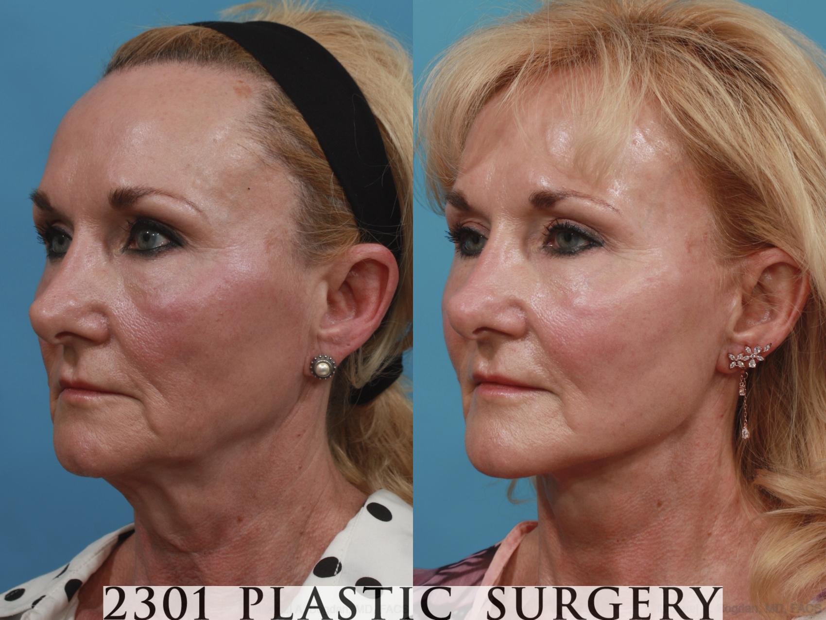 Before & After Face Lift Case 634 Left Oblique View in Fort Worth & Frisco, Texas