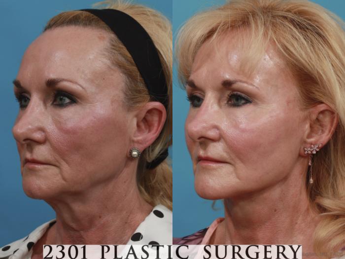 Before & After Blepharoplasty Case 634 Left Oblique View in Fort Worth, Plano, & Frisco, Texas