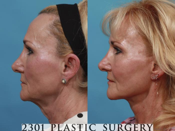 Before & After Neck Lift Case 634 Left Side View in Fort Worth, Plano, & Frisco, Texas
