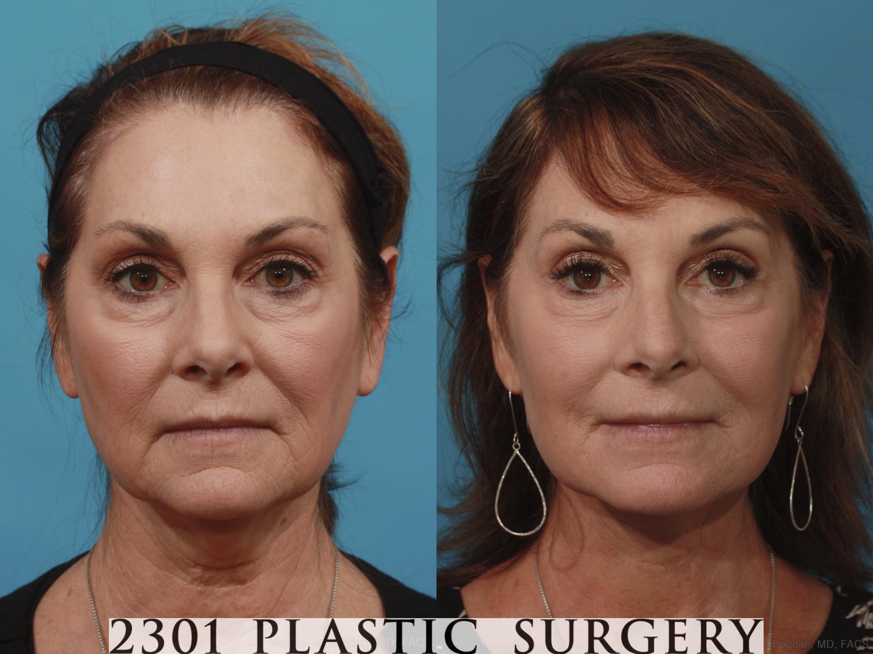 Before & After Face Lift Case 635 Front View in Fort Worth, Plano, & Frisco, Texas